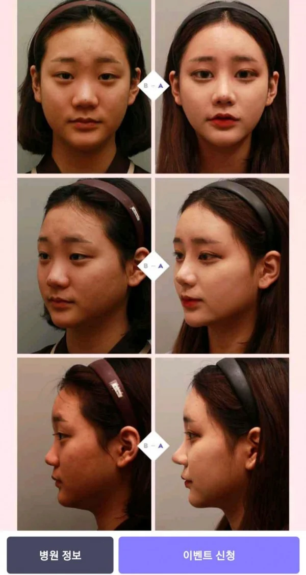 여BJ의 성형전 후