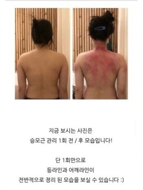 1회 만에 승모근 교정